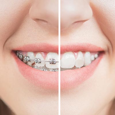 orthodontics before and after braces