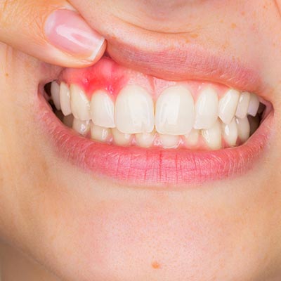 gum disease swollen red gums