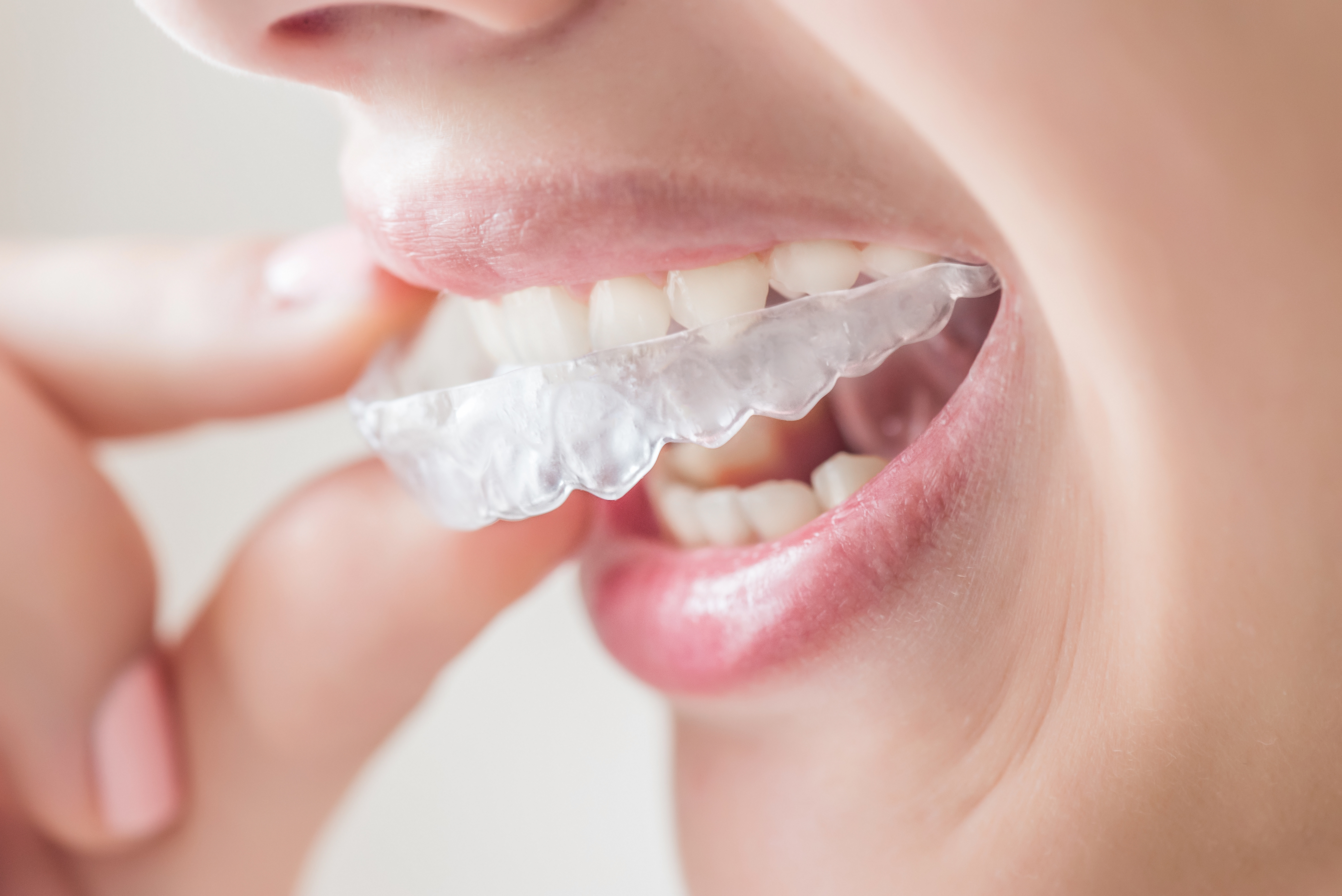 invisible braces clear aligners