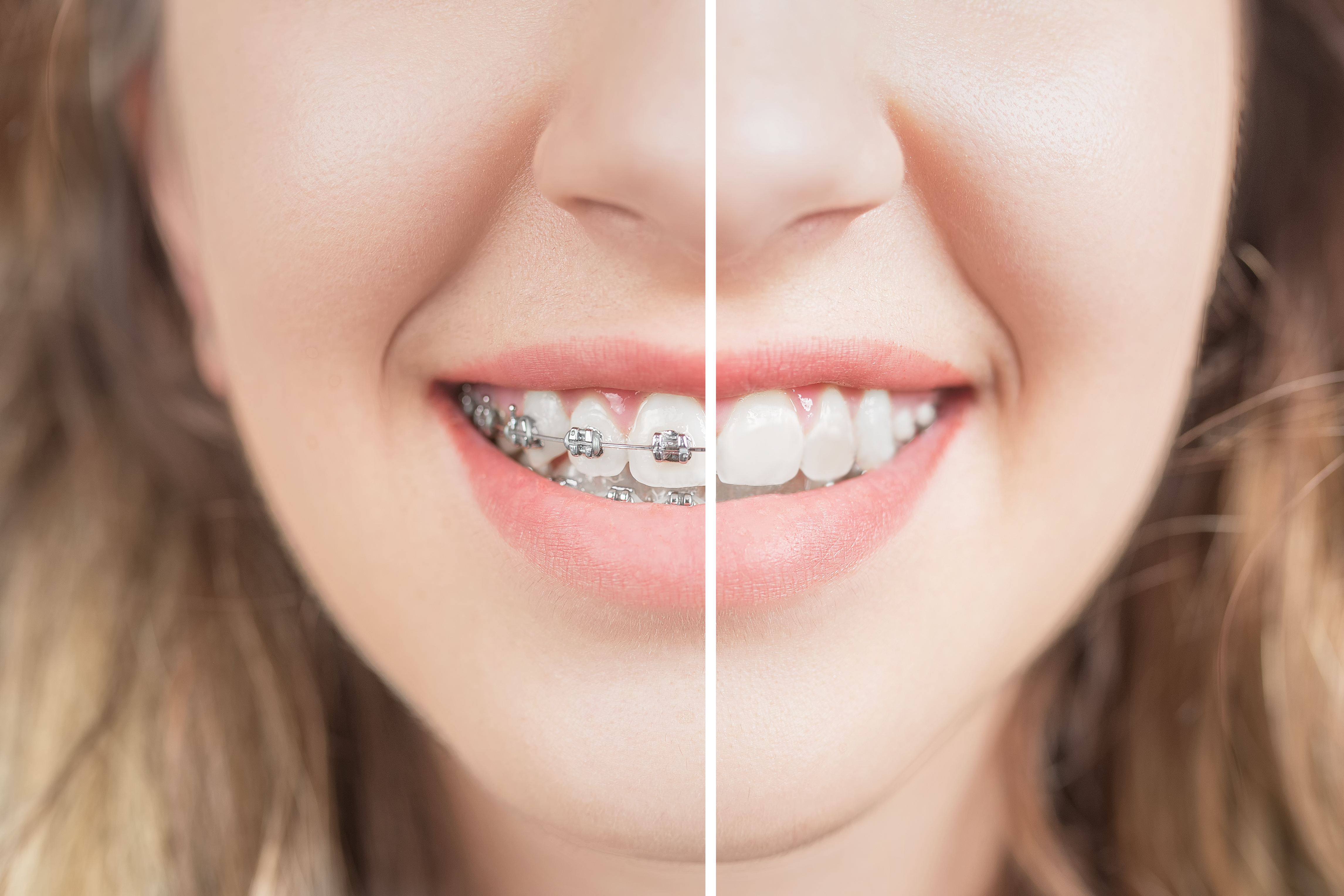 Orthodontics before and after braces
