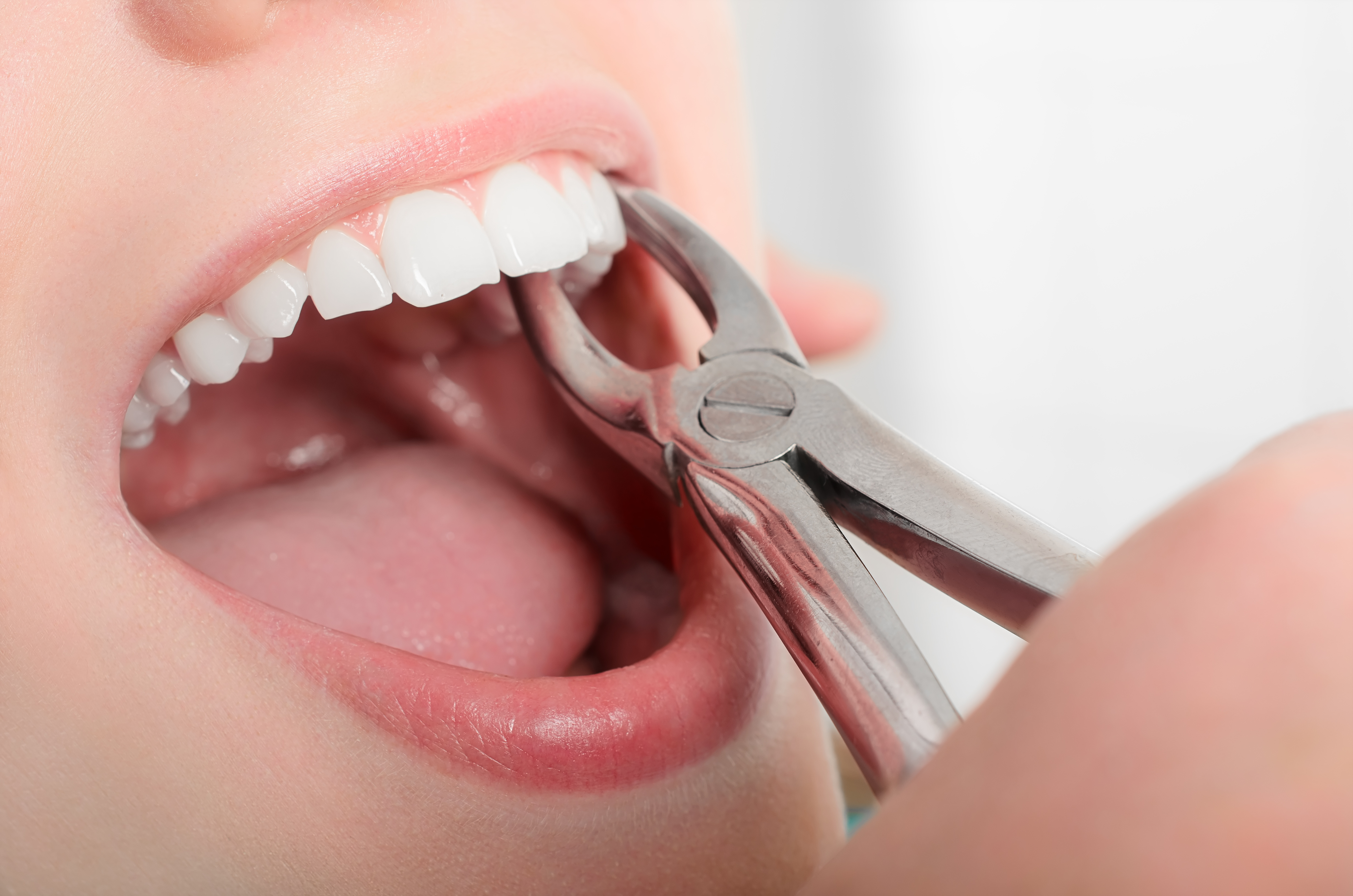 oral surgery extraction